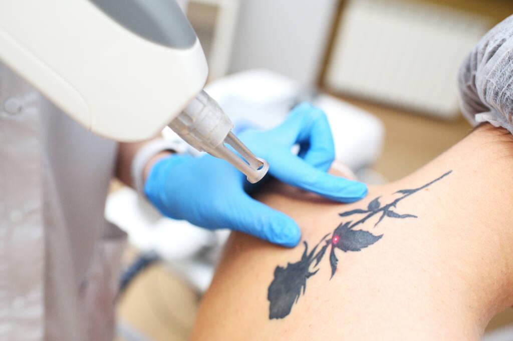 Q-Switch laser technology used for tattoo removal